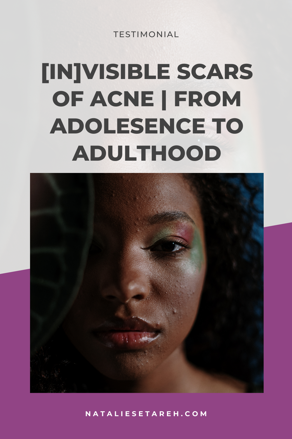 Teenage Acne Scars Adult