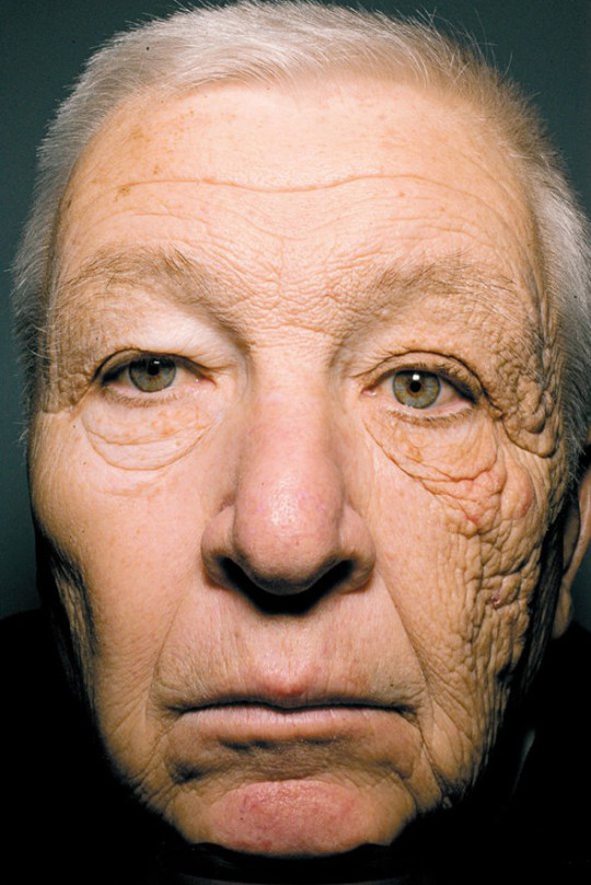 Image of a truck driver with sun damage on one side of their face.