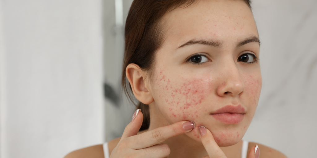 woman with acne issue